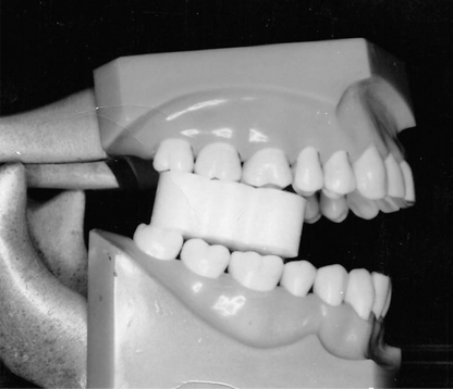 EZ Prop® ­ Disposable Mouth Prop - 100 count